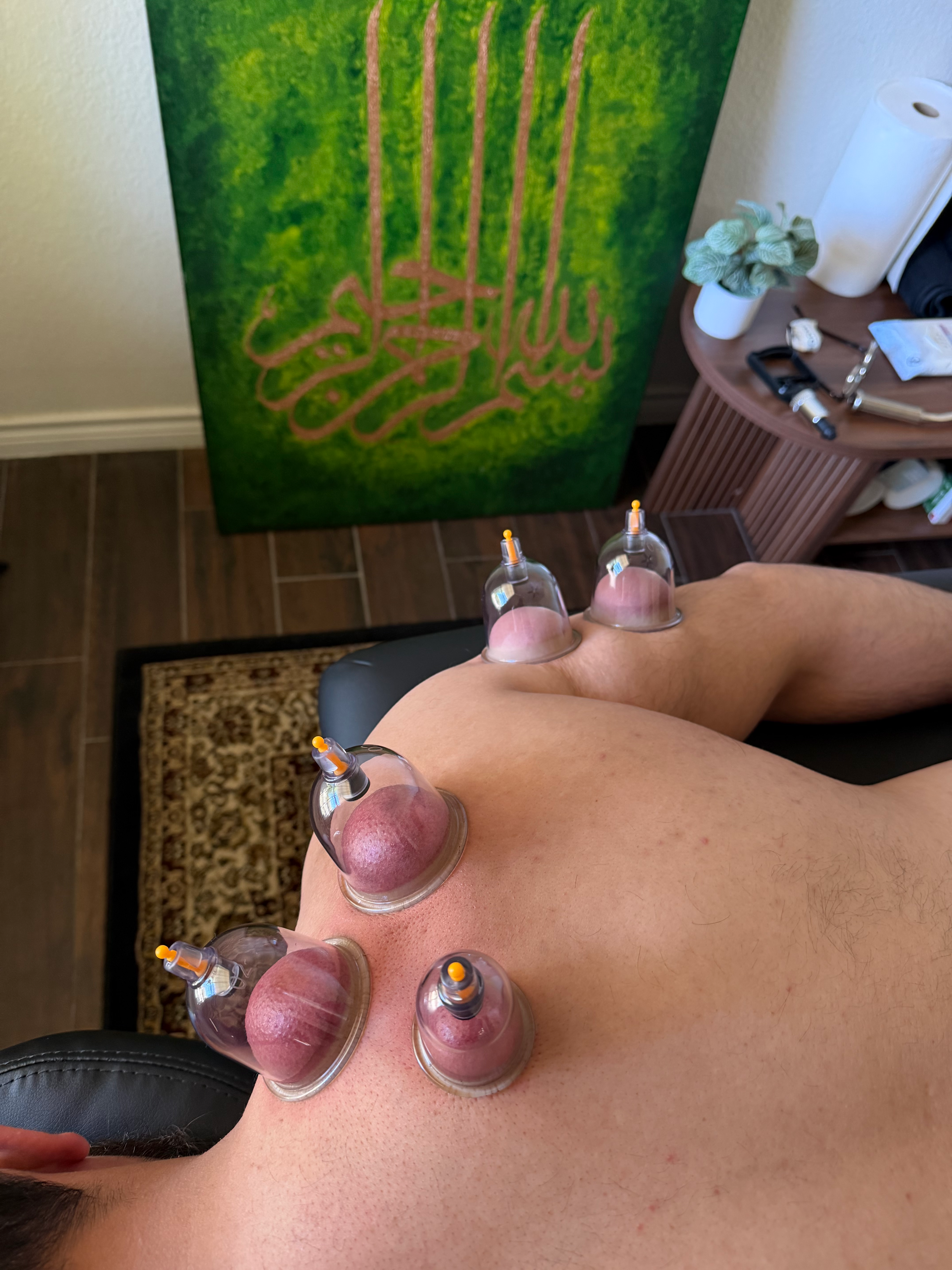 Hijamah cupping treatment — full back view