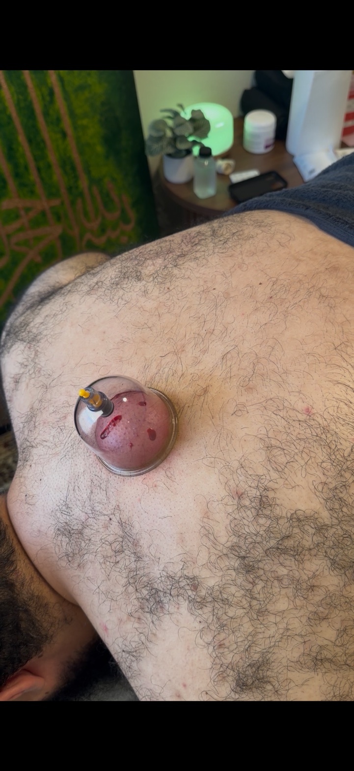 Hijamah wet cupping session