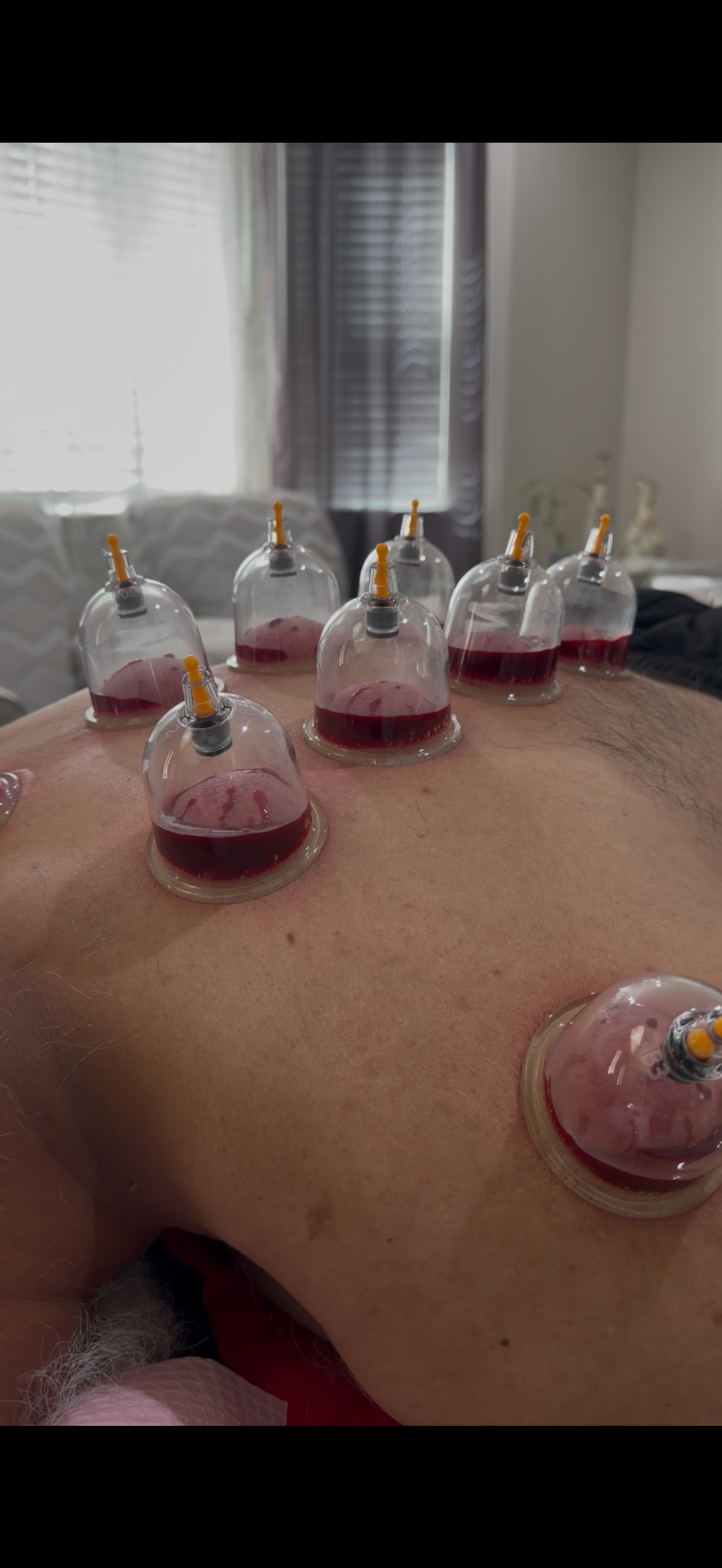 Hijamah cupping therapy session
